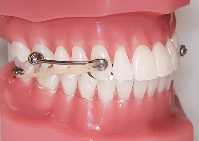 typodont showing an attached Carriere Motion Appliance