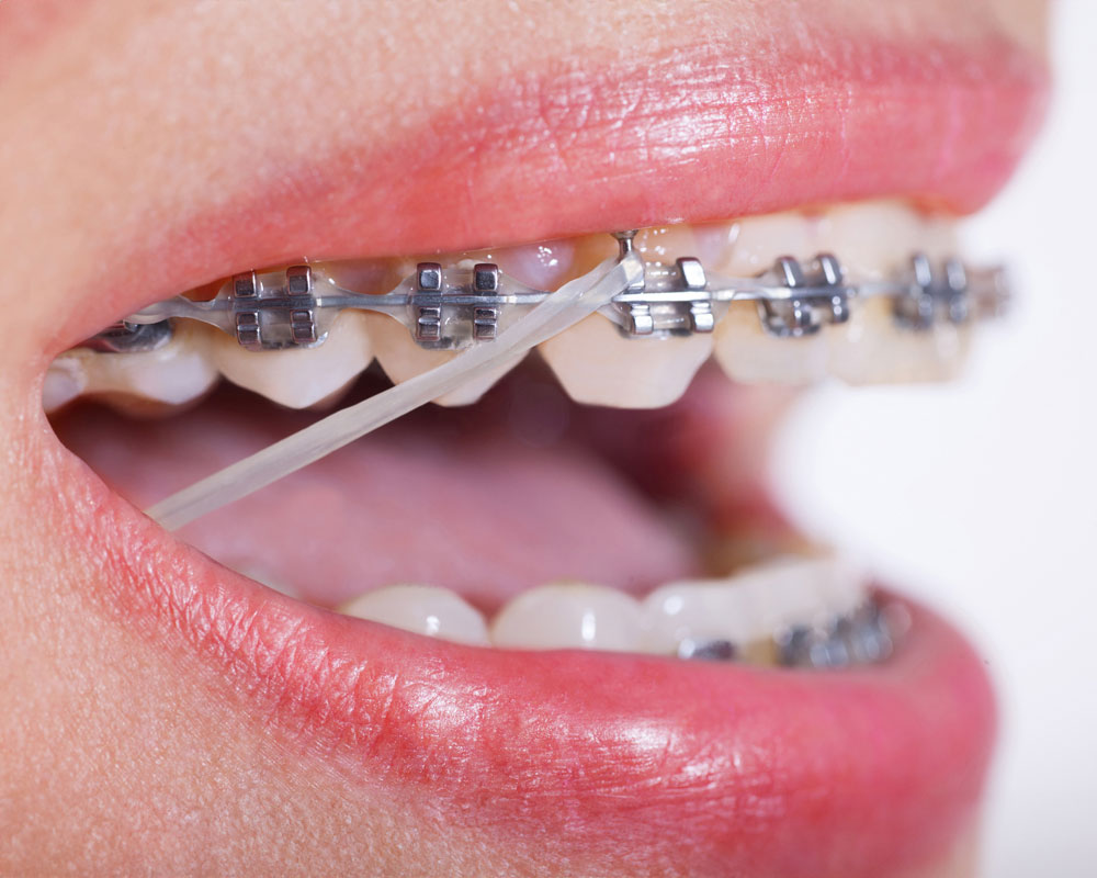 closeup of smile with elastics on braces