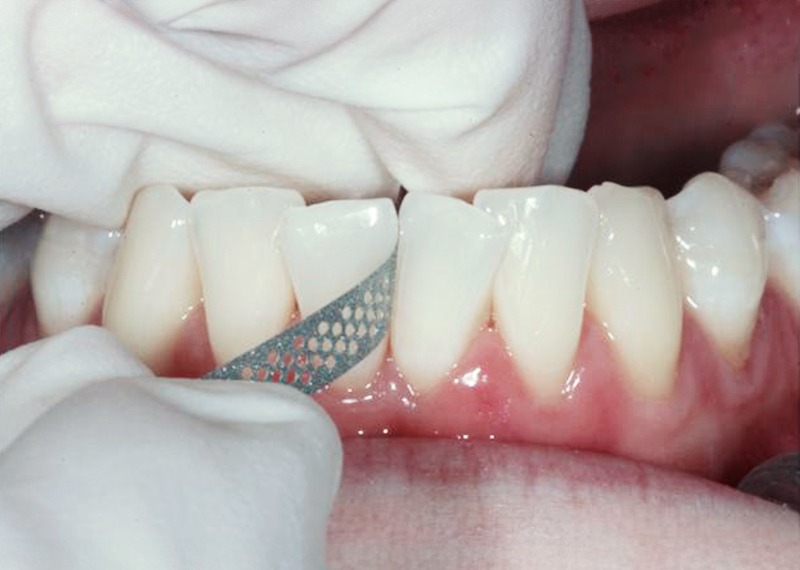 diagram of separators between teeth