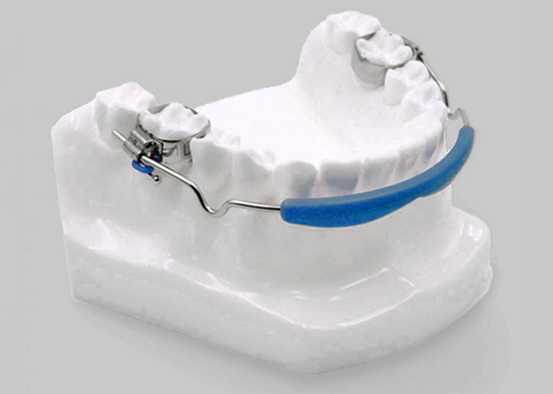 lip bumper on a plaster cast of teeth