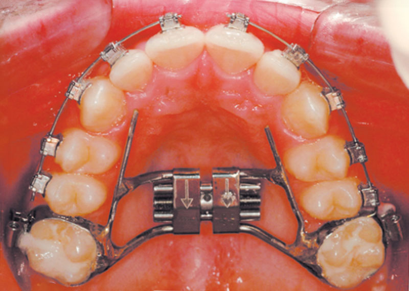 banded expander