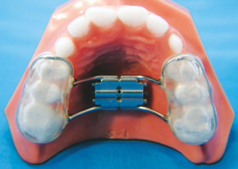 bonded expander