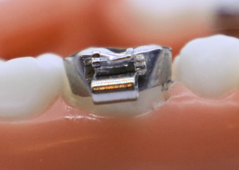 diagram of bands around molars