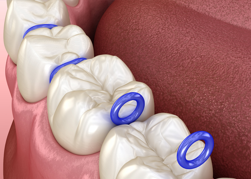 diagram of separators between teeth