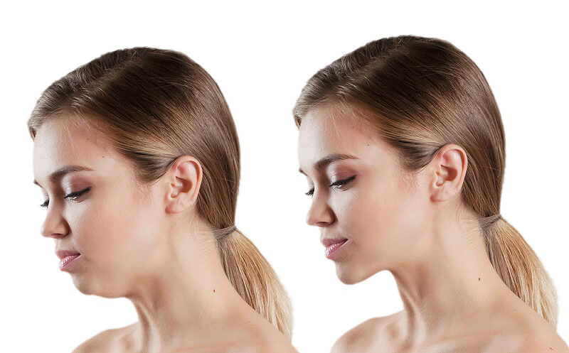 before and after photos of a girl who had corrective jaw surgery done