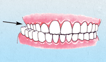 diagram of Crossbite