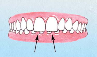 diagram of Overbite