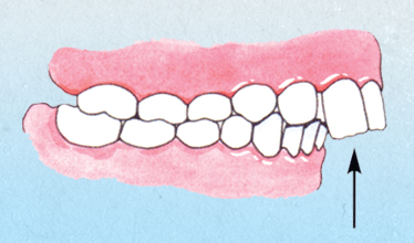 diagram of Protrusion