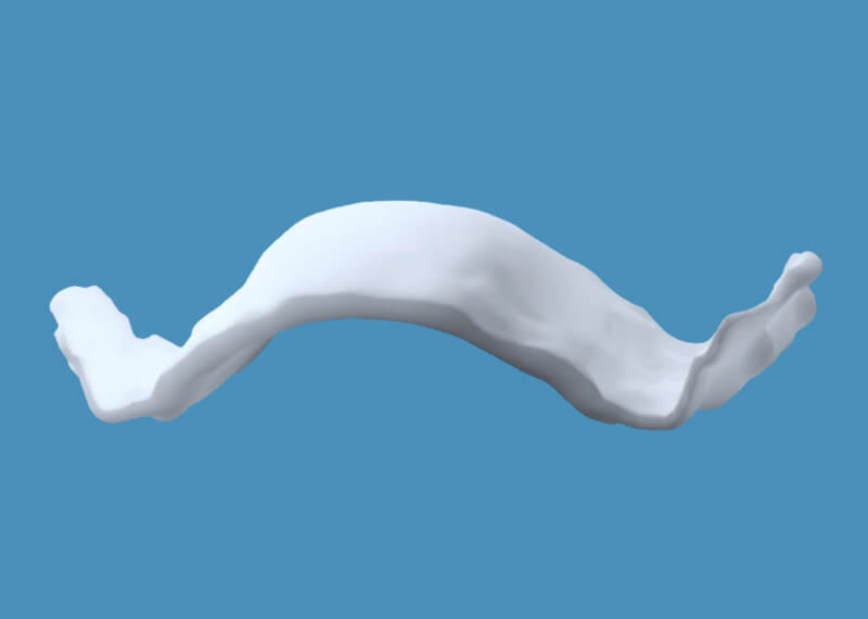 an example of a Invisalign Palatal Expander